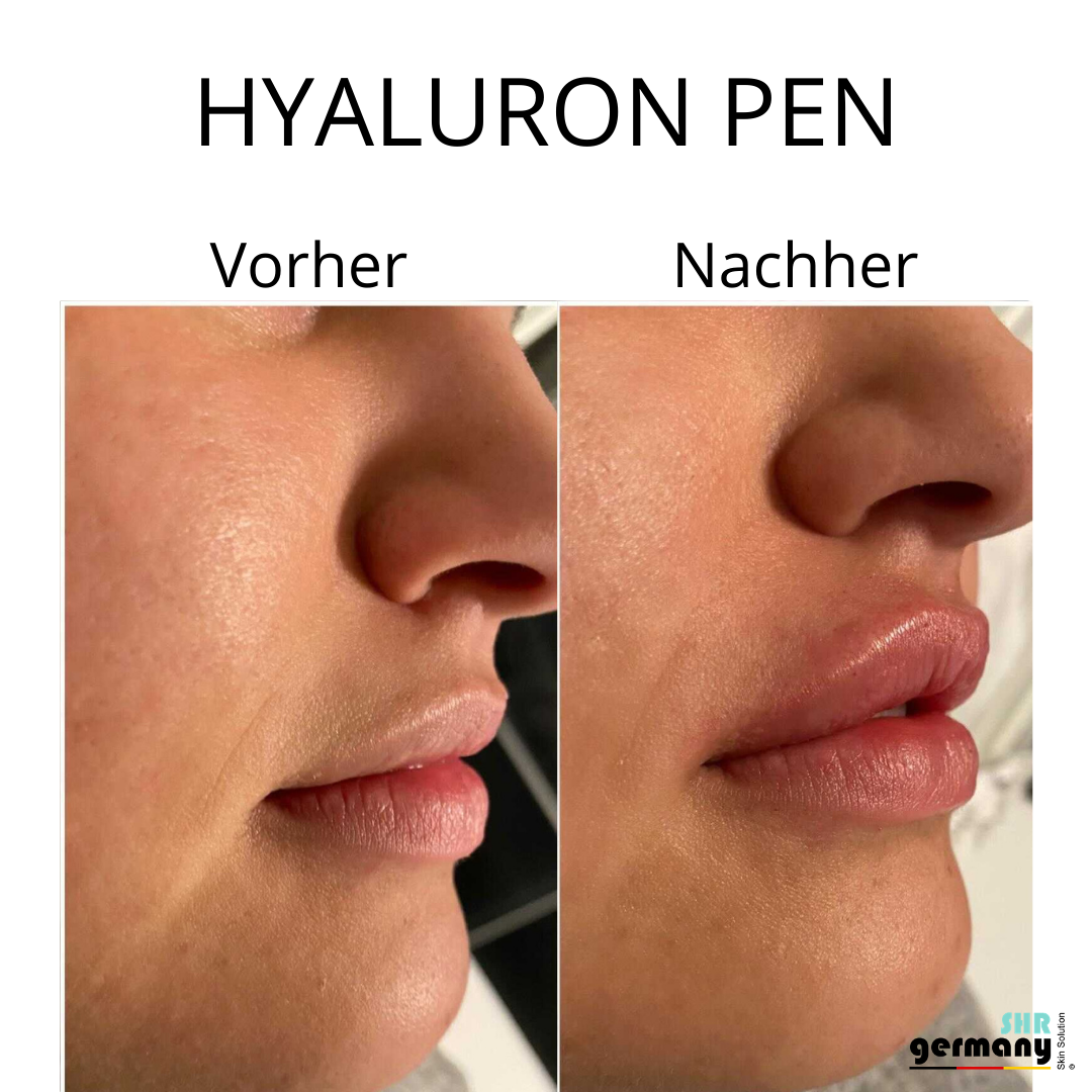 Hyaluron Pen Germany 2021 - silber kaufen!